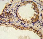IHC testing of FFPE human prostate carcinoma tissue with OASIS antibody. HIER: steam section in pH6 citrate buffer for 20 min and allow to cool prior to staining.