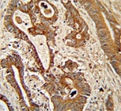 IHC testing of FFPE human colon carcinoma tissue with ETHE1 antibody. HIER: steam section in pH6 citrate buffer for 20 min and allow to cool prior to staining.