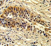 IHC testing of FFPE human lung carcinoma tissue with Transaldolase antibody. HIER: steam section in pH6 citrate buffer for 20 min and allow to cool prior to staining.