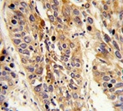 IHC testing of FFPE human lung carcinoma tissue with Leucine-rich alpha-2-glycoprotein antibody. HIER: steam section in pH6 citrate buffer for 20 min and allow to cool prior to staining.