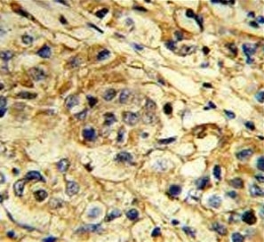 IHC testing of FFPE human breast carcinoma tissue with TIMP1 antibody. HIER: steam section in pH6 citrate buffer for 20 min and allow to cool prior to staining.