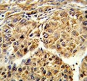 IHC testing of FFPE human hepatocellular carcinoma tissue with Cytochrome p450 2C19 antibody. HIER: steam section in pH6 citrate buffer for 20 min and allow to cool prior to staining.