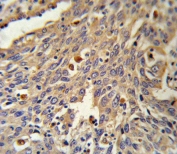 IHC testing of FFPE human lung carcinoma tissue with Galactosidase alpha antibody. HIER: steam section in pH6 citrate buffer for 20 min and allow to cool prior to staining.