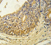 IHC testing of FFPE human prostate carcinoma tissue with Endothelin B Receptor antibody. HIER: steam section in pH6 citrate buffer for 20 min and allow to cool prior to staining.