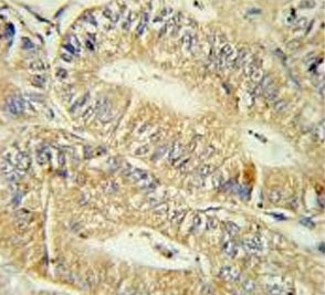 IHC testing of FFPE human colon carcinoma tissue with IRF7 antibody. HIER: steam section in pH6 citrate buffer for 20 min and allow to cool prior to staining.