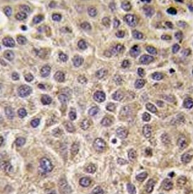 IHC testing of FFPE human hepatocellular carcinoma tissue with MTMR9 antibody. HIER: steam section in pH6 citrate buffer for 20 min and allow to cool prior to staining.