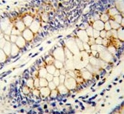 IHC testing of FFPE human colon carcinoma tissue with SRSF1 antibody. HIER: steam section in pH6 citrate buffer for 20 min and allow to cool prior to staining.