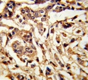 IHC testing of FFPE human breast carcinoma tissue with Galactose-1-phosphate uridylyltransferase antibody. HIER: steam section in pH6 citrate buffer for 20 min and allow to cool prior to staining.