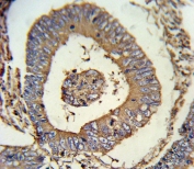 IHC testing of FFPE human colon carcinoma tissue with Calreticulin antibody. HIER: steam section in pH6 citrate buffer for 20 min and allow to cool prior to staining.