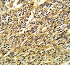 IHC testing of FFPE human lung carcinoma tissue with KCNJ2 antibody. HIER: steam section in pH6 citrate buffer for 20 min and allow to cool prior to staining.
