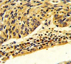 IHC testing of FFPE human lung carcinoma tissue with FPGS antibody. HIER: steam section in pH6 citrate buffer for 20 min and allow to cool prior to staining.
