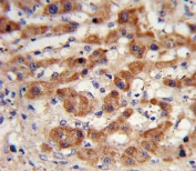 IHC testing of FFPE human hepatocellular carcinoma tissue with NAT antibody. HIER: steam section in pH6 citrate buffer for 20 min and allow to cool prior to staining.