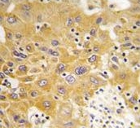 IHC testing of FFPE human hepatocellular carcinoma tissue with CAMK1 delta antibody. HIER: steam section in pH6 citrate buffer for 20 min and allow to cool prior to staining.