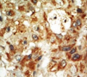 IHC testing of FFPE human cancer tissue with MAPK12 antibody. HIER: steam section in pH6 citrate buffer for 20 min and allow to cool prior to staining.