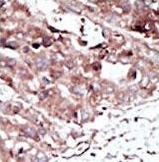 IHC testing of FFPE human cancer tissue with PHKG2 antibody. HIER: steam section in pH6 citrate buffer for 20 min and allow to cool prior to staining.
