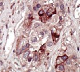 IHC testing of FFPE human cancer tissue with PHKG2 antibody. HIER: steam section in pH6 citrate buffer for 20 min and allow to cool prior to staining.