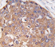 IHC testing of FFPE human breast carcinoma tissue with Polo-like kinase 2 antibody. HIER: steam section in pH6 citrate buffer for 20 min and allow to cool prior to staining.