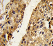 IHC testing of FFPE human hepatocellular carcinoma tissue with Pigment epithelium-derived factor antibody. HIER: steam section in pH6 citrate buffer for 20 min and allow to cool prior to staining.