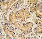 IHC testing of FFPE human prostate carcinoma tissue with MOB kinase activator 1A antibody. HIER: steam section in pH6 citrate buffer for 20 min and allow to cool prior to staining.