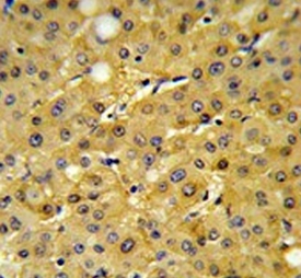 IHC testing of FFPE human hepatocellular carcinoma tissue with Fructose-1,6-bisphosphatase 1 antibody. HIER: steam section in pH6 citrate buffer for 20 min and allow to cool prior to staining.