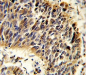 IHC testing of FFPE human lung carcinoma tissue with Vitronectin antibody. HIER: steam section in pH6 citrate buffer for 20 min and allow to cool prior to staining.