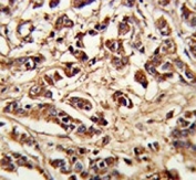IHC testing of FFPE human breast carcinoma tissue with Pericentriolar material 1 protein antibody. HIER: steam section in pH6 citrate buffer for 20 min and allow to cool prior to staining.