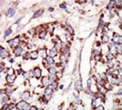 IHC testing of FFPE human cancer tissue with MAPK3 antibody. HIER: steam section in pH6 citrate buffer for 20 min and allow to cool prior to staining.