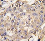 IHC testing of FFPE human breast cancer tissue with MAPK3 antibody. HIER: steam section in pH6 citrate buffer for 20 min and allow to cool prior to staining.