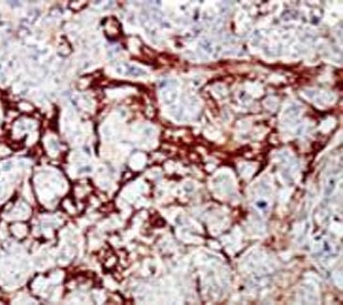 IHC testing of FFPE human cancer tissue with CDKL1 antibody. HIER: steam section in pH6 citrate buffer for 20 min and allow to cool prior to staining.