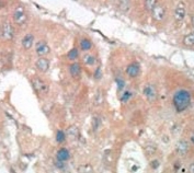 IHC testing of FFPE human cancer tissue with p21WAF1 antibody. HIER: steam section in pH6 citrate buffer for 20 min and allow to cool prior to staining.