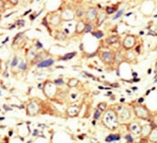 IHC testing of FFPE human breast cancer tissue with ErbB2 antibody. HIER: steam section in pH6 citrate buffer for 20 min and allow to cool prior to staining.