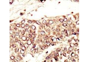 IHC testing of FFPE human cancer tissue with IGF1 Receptor antibody. HIER: steam section in pH6 citrate buffer for 20 min and allow to cool prior to staining.