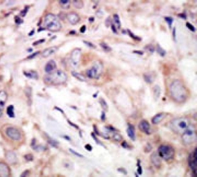 IHC testing of FFPE human cancer tissue with ROR2 antibody. HIER: steam section in pH6 citrate buffer for 20 min and allow to cool prior to staining.