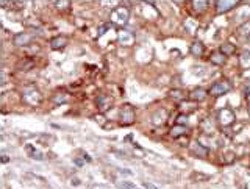 IHC testing of FFPE human cancer tissue with BLK antibody. HIER: steam section in pH6 citrate buffer for 20 min and allow to cool prior to staining.