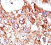 IHC testing of FFPE human cancer tissue with Spleen tyrosine kinase antibody. HIER: steam section in pH6 citrate buffer for 20 min and allow to cool prior to staining.