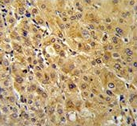 IHC testing of FFPE human hepatocellular carcinoma tissue with FKBP1A antibody. HIER: steam section in pH6 citrate buffer for 20 min and allow to cool prior to staining.