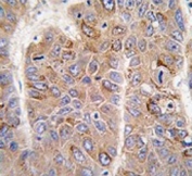 IHC testing of FFPE human hepatocellular carcinoma tissue with Insulin receptor substrate 2 antibody. HIER: steam section in pH6 citrate buffer for 20 min and allow to cool prior to staining.