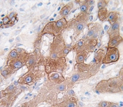IHC testing of FFPE human hepatocellular carcinoma tissue with Cytochrome P450 3A5 antibody. HIER: steam section in pH6 citrate buffer for 20 min and allow to cool prior to staining.