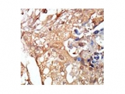 IHC testing of FFPE human breast cancer tissue with RAF1 antibody. HIER: steam section in pH6 citrate buffer for 20 min and allow to cool prior to staining.