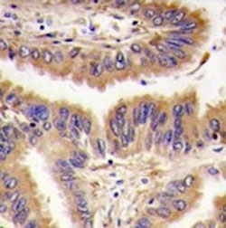 IHC testing of FFPE human lung carcinoma tissue with Protein-glutamine gamma-glutamyltransferase 2 antibody. HIER: steam section in pH6 citrate buffer for 20 min and allow to cool prior to staining.
