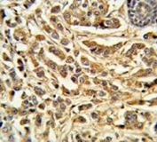 IHC testing of FFPE human breast carcinoma tissue with Steroid 21-hydroxylase antibody. HIER: steam section in pH6 citrate buffer for 20 min and allow to cool prior to staining.