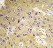 IHC testing of FFPE human hepatocellular carcinoma tissue with SGK3 antibody. HIER: steam section in pH6 citrate buffer for 20 min and allow to cool prior to staining.
