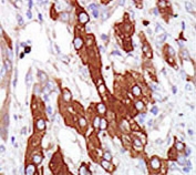 IHC testing of FFPE human cancer tissue with SGK3 antibody. HIER: steam section in pH6 citrate buffer for 20 min and allow to cool prior to staining.