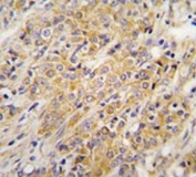 IHC testing of FFPE human prostate carcinoma tissue with MAP2K2 antibody. HIER: steam section in pH6 citrate buffer for 20 min and allow to cool prior to staining.