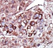 IHC testing of FFPE human cancer tissue with DGKZ antibody. HIER: steam section in pH6 citrate buffer for 20 min and allow to cool prior to staining.