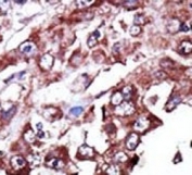 IHC testing of FFPE human cancer tissue with NME7 antibody. HIER: steam section in pH6 citrate buffer for 20 min and allow to cool prior to staining.