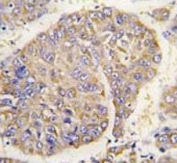 IHC testing of FFPE human hepatocellular carcinoma tissue with PBP antibody. HIER: steam section in pH6 citrate buffer for 20 min and allow to cool prior to staining.