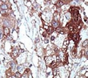 IHC testing of FFPE human cancer tissue with PBP antibody. HIER: steam section in pH6 citrate buffer for 20 min and allow to cool prior to staining.