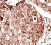 IHC testing of FFPE human cancer tissue with Phosphatidylethanolamine-binding protein 1 antibody. HIER: steam section in pH6 citrate buffer for 20 min and allow to cool prior to staining.