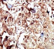 IHC testing of FFPE human breast cancer tissue with PEPCK2 antibody. HIER: steam section in pH6 citrate buffer for 20 min and allow to cool prior to staining.